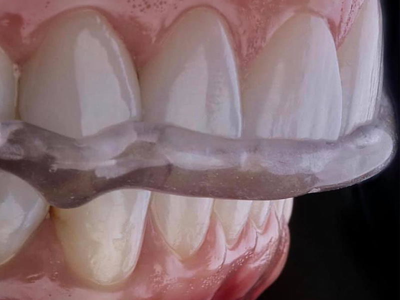 1+1 Férula Dental Placa de Descarga Nocturna - Protector Bucal para dormir  anti Bruxismo Rechinar los dientes y los Trastornos del ATM - Con
