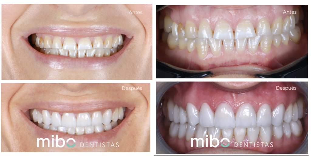 carillas_dentales_sintallado_almeria_mibo