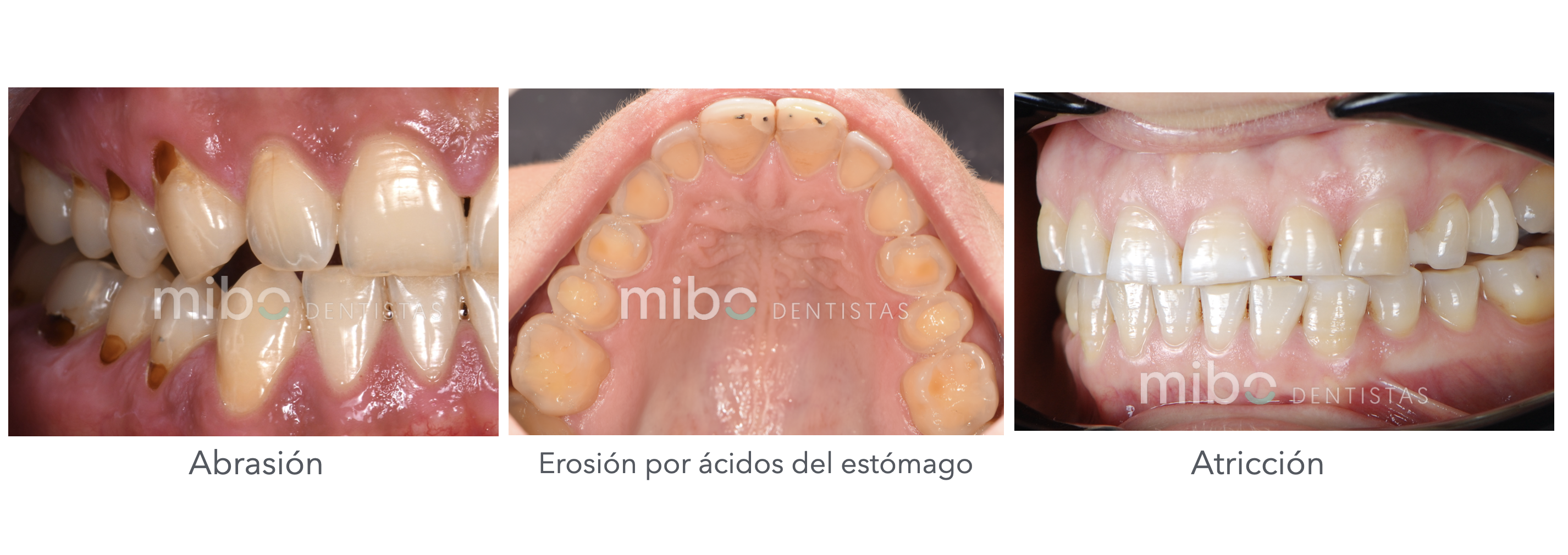 desgaste dental carillas dentales almeria incrustaciones dentales