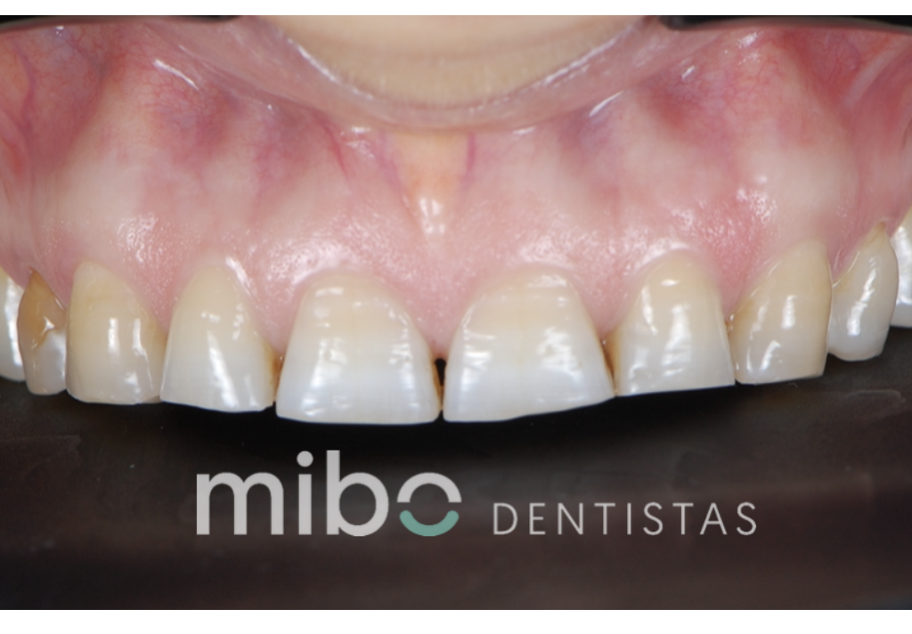 desgastes dentales almeria incrustaciones carillas dentales